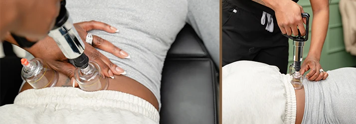 Chiropractor Christy Onya performs cupping therapy on a patient's lower back using a handheld device.